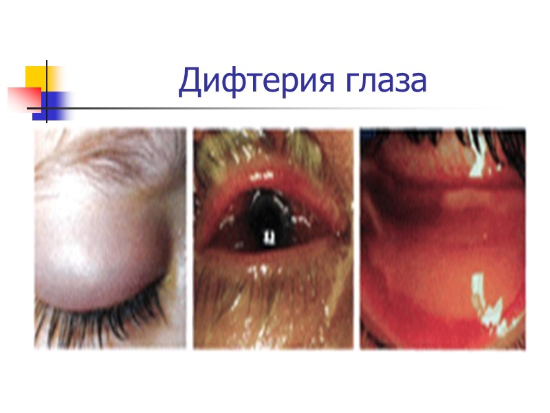 Дифтерия Дифтерия – острое инфекционное заболевание, характеризующееся фибринозным воспалением в месте внедрения возбудителя и