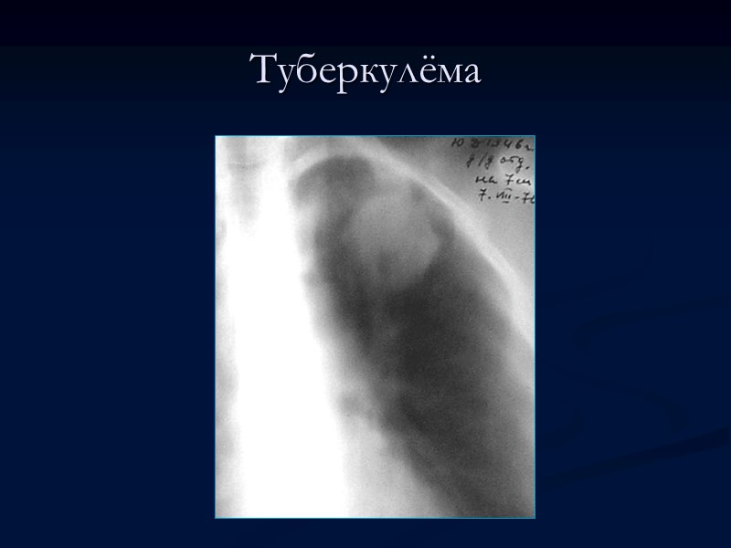 Туберкулёма Туберкулёма лёгкого — относительно благоприятная форма туберкулёза, характеризующаяся казеозным фокусом, окружённым соединительнотканной капсулой