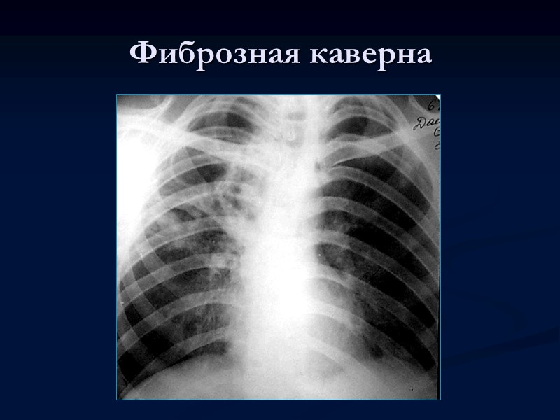 Кавернозный туберкулез легких    Кавернозный туберкулез легких характеризуется наличием сформированной полости распада