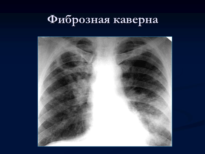 Кавернозный туберкулез легких    В зависимости от степени выраженности воспалительных изменений в