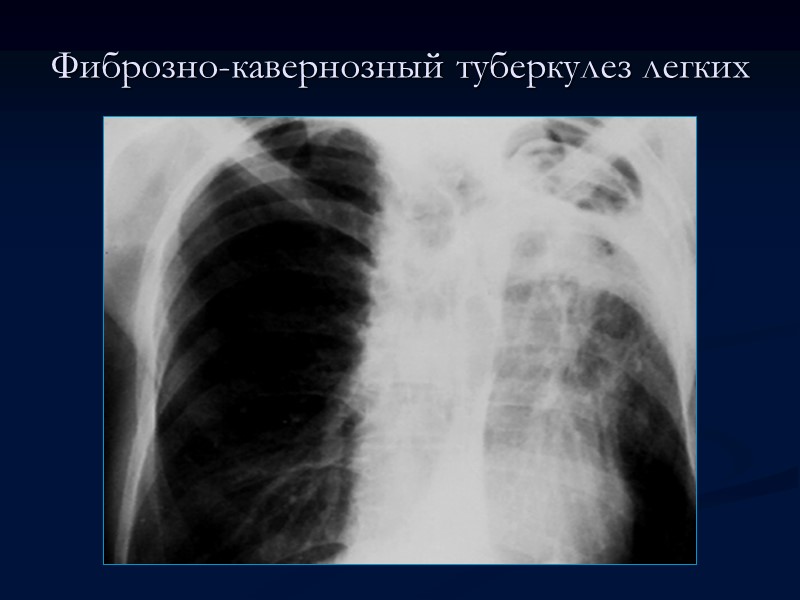 Фиброзно-кавернозный туберкулез легких Фиброзно-кавернозный туберкулез легких характеризуется наличием фиброзной каверны, развитием фиброзных изменений в