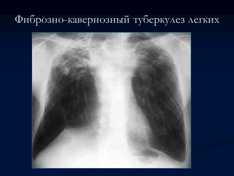 Фиброзно-кавернозный туберкулез легких Различают три клинических варианта течения фиброзно-кавернозного туберкулеза легких:  Ограниченный и