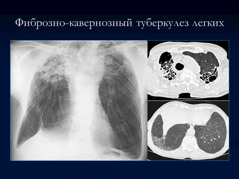 Фиброзно-кавернозный туберкулез легких  Фиброзно-кавернозный туберкулез легких. Обзорный снимок