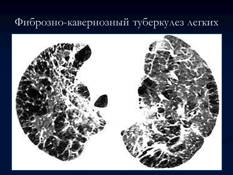 Фиброзно-кавернозный туберкулез легких Каверна с уровнем жидкости. Обзорный снимок.