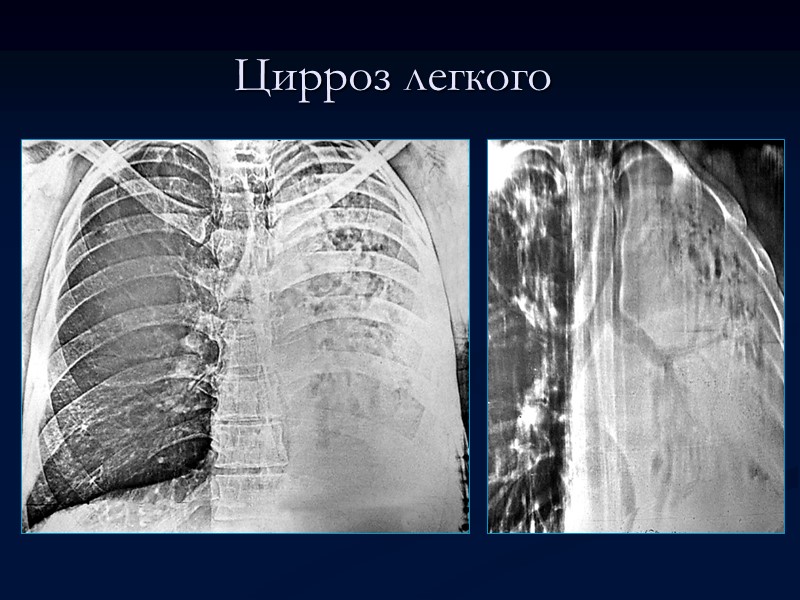 Цирроз легкого   Рентгенологическая картина сходна с изменениями при фиброзно-кавернозном туберкулезе, следствием которого