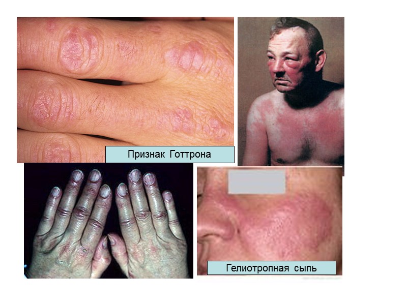 Критерии ССД  (2 больших +1 малый) «Большие» критерии: склероз/индурация, склеродактилия, синдром Рейно. «Малые