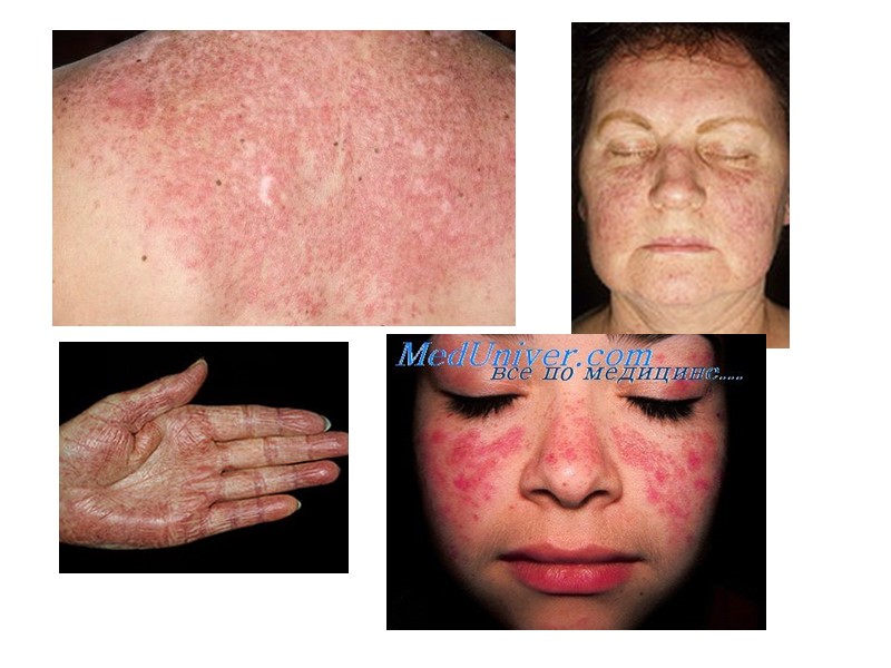 Этиология СКВ Генетические факторы: наличие семейных случаев, СКВ у 30% монозиготных и только у