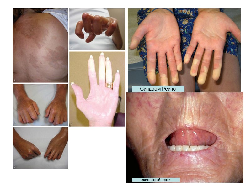 Клиника СКВ Кожа и слизистые (бабочка, капиллярит, люпус-хейлит). Суставы и мышцы: артралгии и артриты