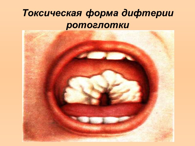 Классификация дифтерии  (М.Х.Турьянов, Н.М. Беляева) По ведущему синдрому: Кардиопатия Нефропатия Нейропатия Энцефалопатия Пневмопатия