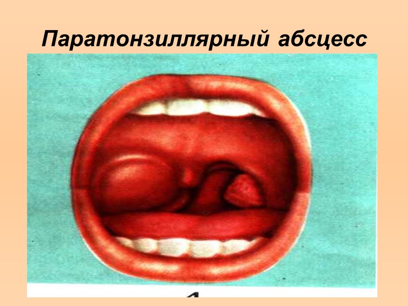 Дифтерия гортани (пленки на голосовых связках).