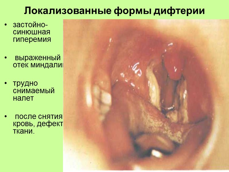 бактериологическое исследование микрофлоры поверхности миндалин      рост бета гемолитических стрептококков