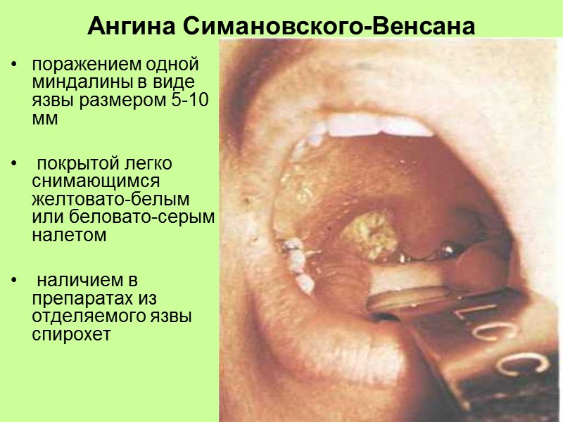 Перитонзиллит высокая лихорадка  Постоянные односторонние боли в ротоглотке  резко усиливающихся при глотании
