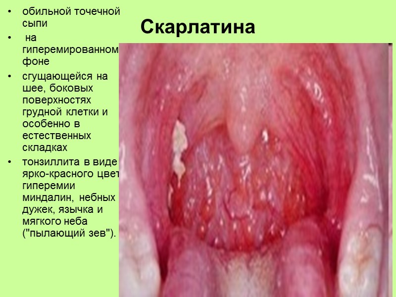 Гиперемия   Отек      небной дужки на стороне поражения