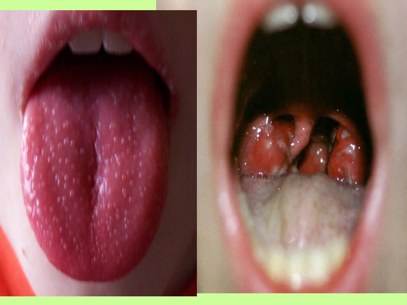 хронический тонзиллит  Постепенное начало   вялое и продолжительное течение   