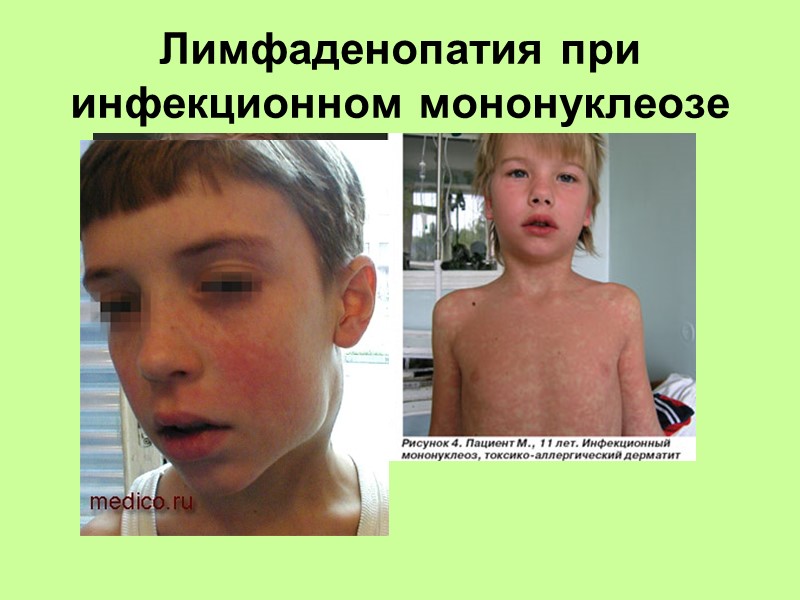 застойная гиперемия  гипертрофия 3 степени миндалин  рубцово измененных и спаянных с небными