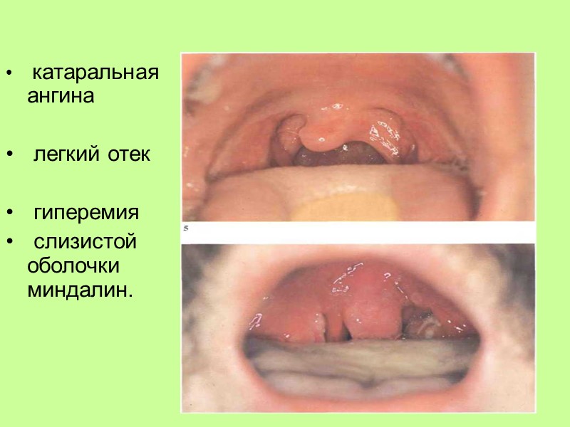 В России острый тонзллит ежегодно переносят около 10 млн человек,   80 %