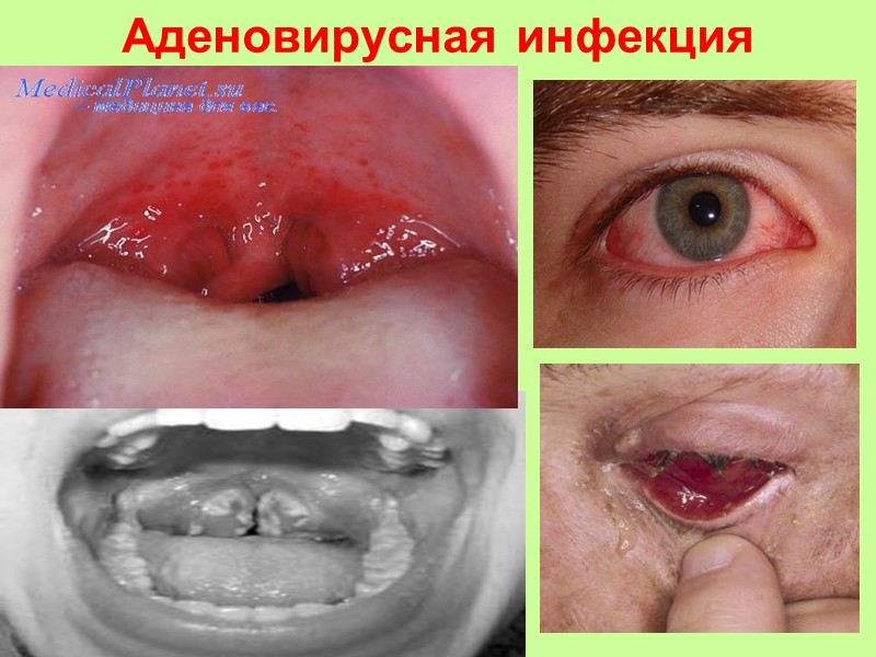 Ангина Симановского-Венсана   (фузоспирохетоз)   незначительно выраженными общими проявлениями интоксикации  