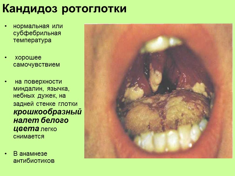 Лимфаденопатия при инфекционном мононуклеозе