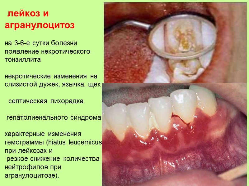 Инфекционный мононуклеоз   полиаденит   гепатоспленомегалия   Лимфомоноцитоз  экзантема 