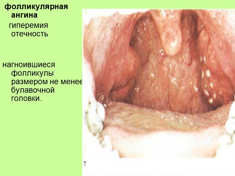 возбудителями ангины –   стрептококки,   стафилококки,   диплококки,  