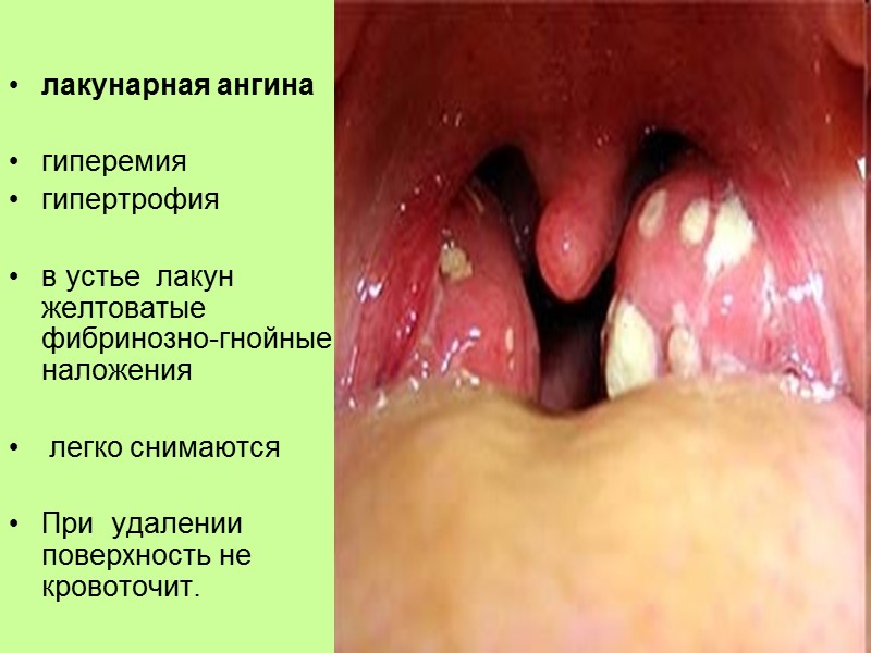 Пути передачи  экзогенный : воздушно-капельным   травматические: ангины после операций на задних