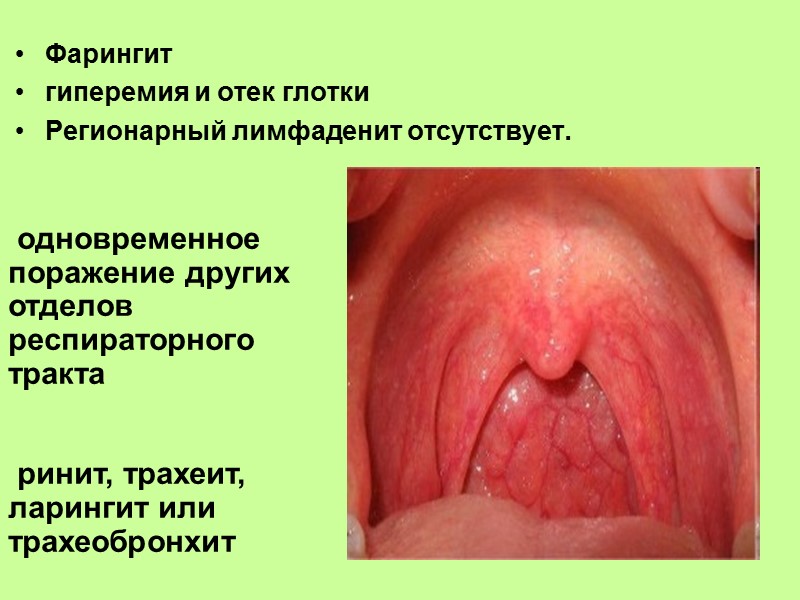 Катаральные  Фолликулярные  Лакунарные