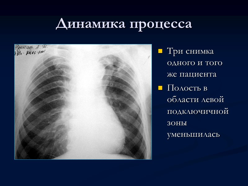 Первичный туберкулезный комплекс  Раличают четыре стадии его развития: I стадия — пневмоническая 