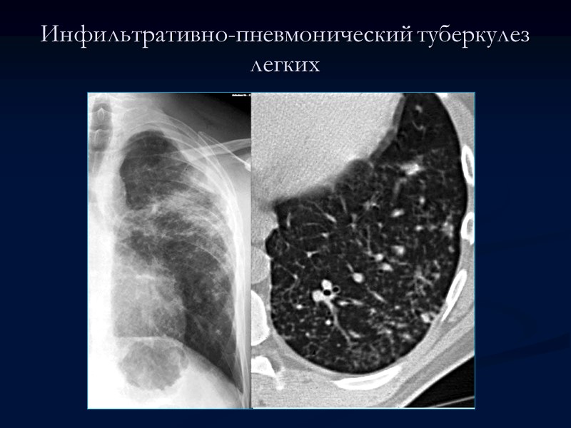 Казеозная пневмония лобарная Лобарная казеозная пневмония фактически является вариантом инфильтративного туберкулеза и представлена поражением