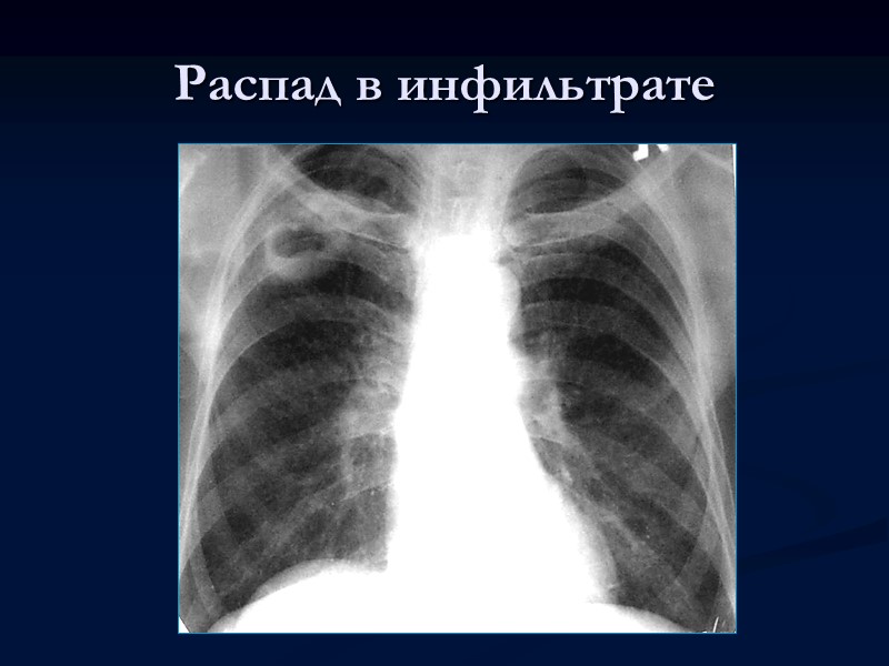 Казеозная пневмония лобулярная При лобулярной казеозной пневмонии очаговые тени размером 1,0 —1,5 см. располагаются