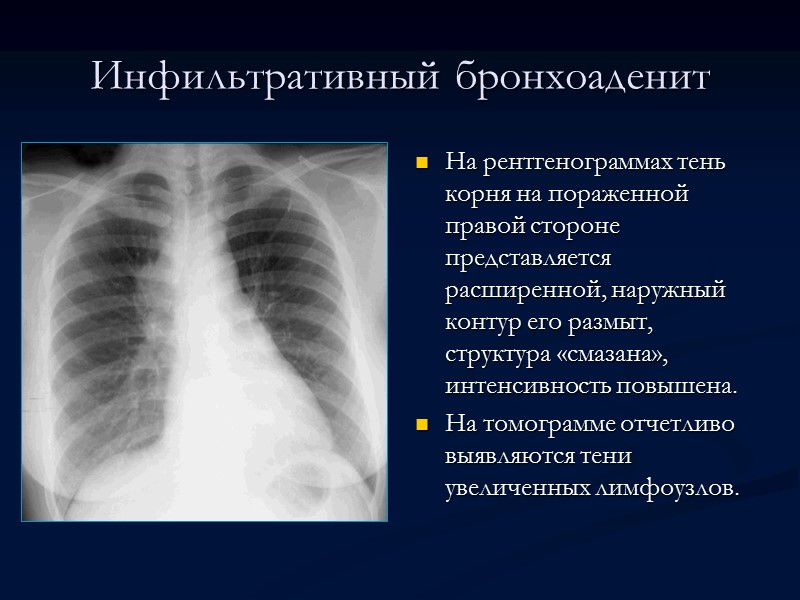 Милиарный туберкулез   легких Мелкоочаговая диссеминация