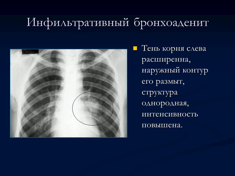Милиарный туберкулез   легких Мелкоочаговая  диссеминация, преобладание слева вверху