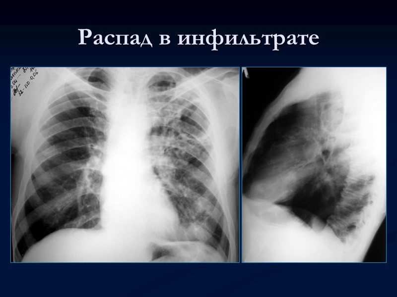 Классификация туберкулеза Предже всего (в упрощенном виде) принято различать лёгочный и внелёгочный туберкулёз По