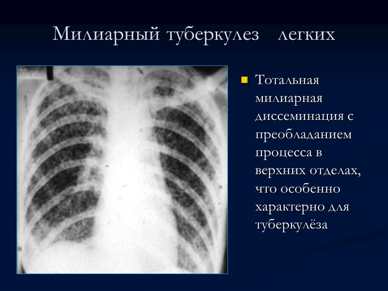 Хронический диссеминированный туберкулез