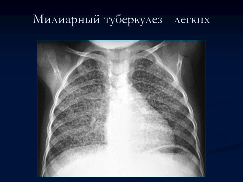 Хронический диссеминированный туберкулез