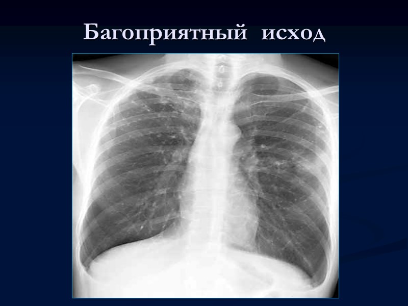 Классификация ТВС органов дыхания Первичный туберкулезный комплекс Бронхоадениты (ТВС внутригрудных лимфатических узлов) Диссеминированный 