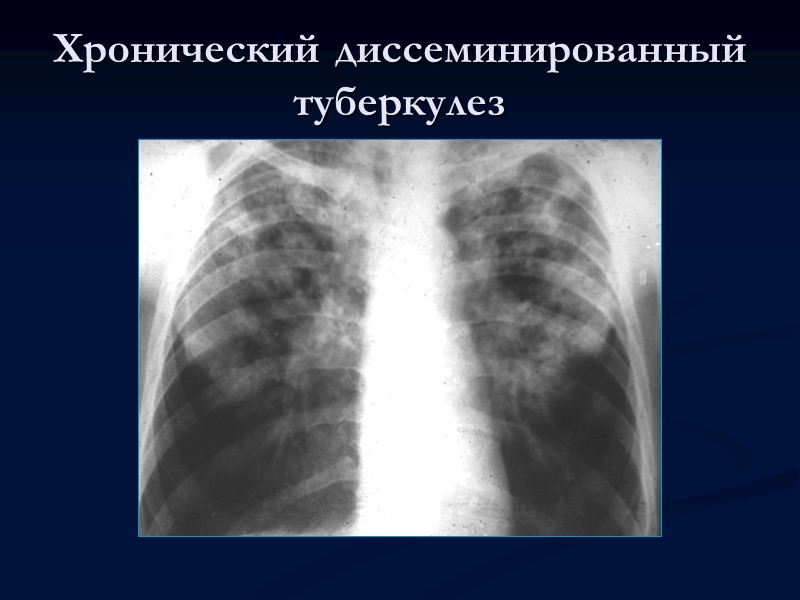 Очаговый туберкулез легких.  Очаговый туберкулез легких характеризуется наличием немногочисленных очагов, преимущественно продуктивного характера,