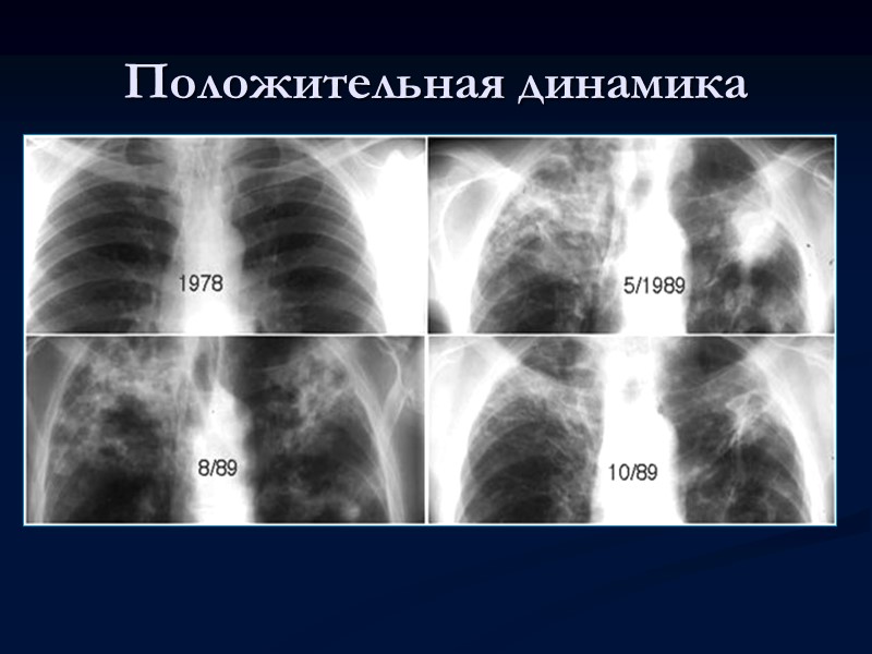 Рентгенологические симптомы и синдромы При легочном туберкулезе встречается крайнее разнообразие симптомов и их сочетаний.