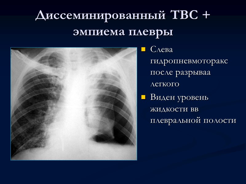 Инфильтративно-пневмонический туберкулез легких  Peнтгенологически, чаще всего в верхних отделах легких, определяются инфильтративные фокусы