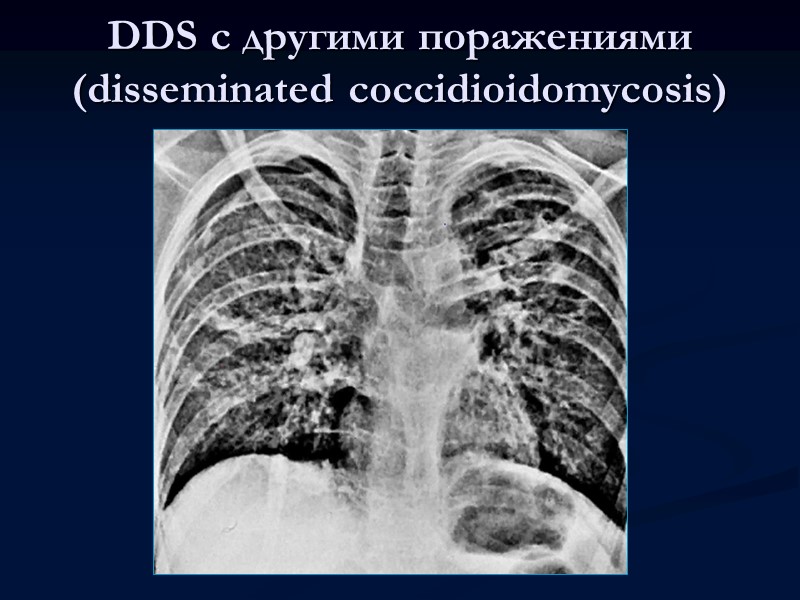 Инфильтративно-пневмонический туберкулез легких