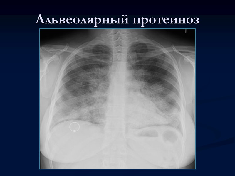 Инфильтративно-пневмонический туберкулез легких