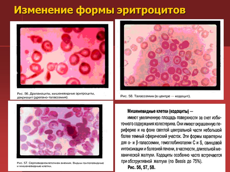 Апластическая анемия картина крови