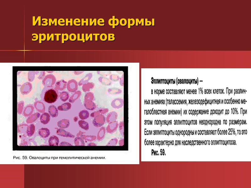 Картина крови при апластической анемии