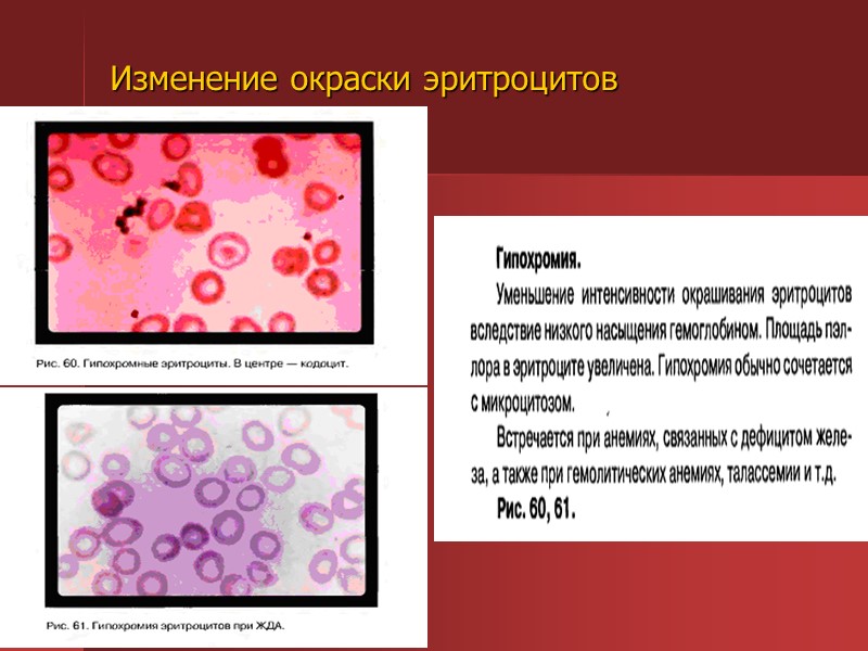 Анемия и эритроциты в крови. Б12 дефицитная анемия кровь. Б12 анемия тельца. Картина крови фолиеводефицитной анемии.