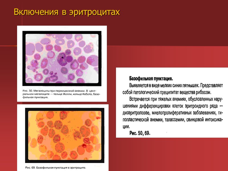 Картина крови при апластической анемии