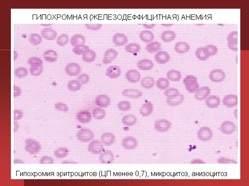 Гипохромная анемия пойкилоцитоз. Анизоцитоз микроцитоз анемия.