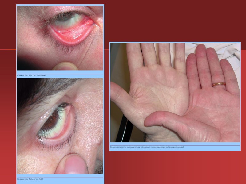 Имеет значение стадия течения анемии. 1.Скрытый дефицит железа, проявляющийся снижением уровня сывороточного железа при Имеет значение стадия течения анемии. 1.Скрытый дефицит железа, проявляющийся снижением уровня сывороточного железа при