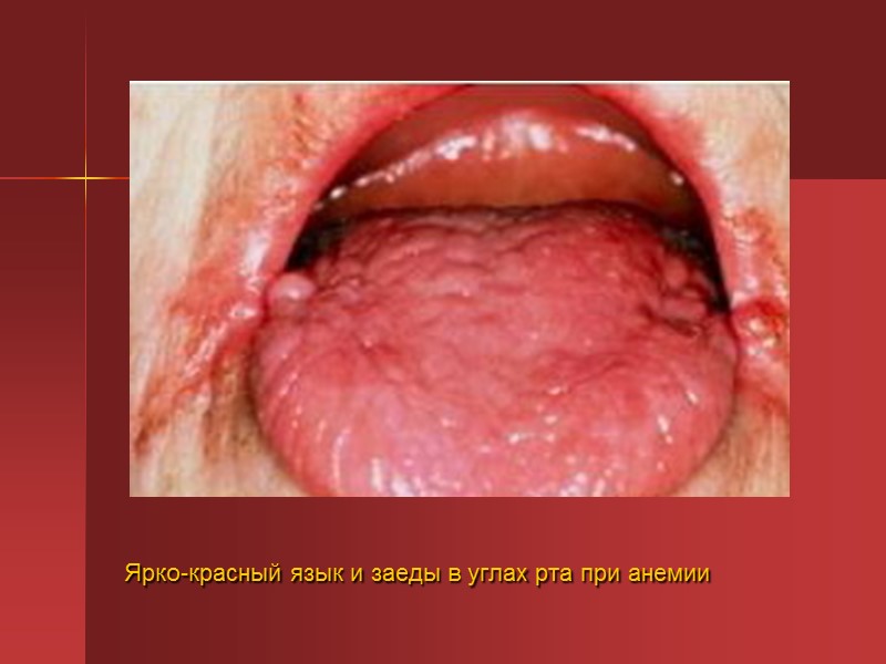 Диагностика. При постановке диагноза ЖДА выделяют два этапа: Доказательство дефицита железа в организме Диагностика. При постановке диагноза ЖДА выделяют два этапа: Доказательство дефицита железа в организме