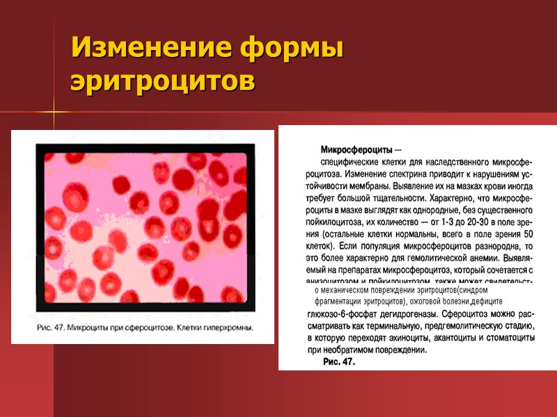 Изменение формы эритроцитов Изменение формы эритроцитов