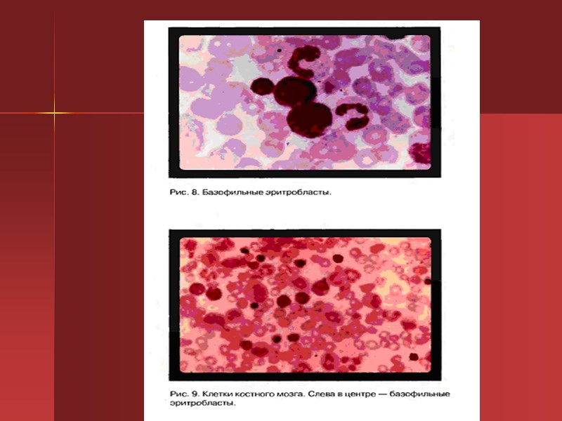 Диагностика талассемии Выраженная гемолитическая анемия с гипохромными микроцитарными эритроцитами. Анизоцитоз, множество мишеневидных эритроцитов, а Диагностика талассемии Выраженная гемолитическая анемия с гипохромными микроцитарными эритроцитами. Анизоцитоз, множество мишеневидных эритроцитов, а