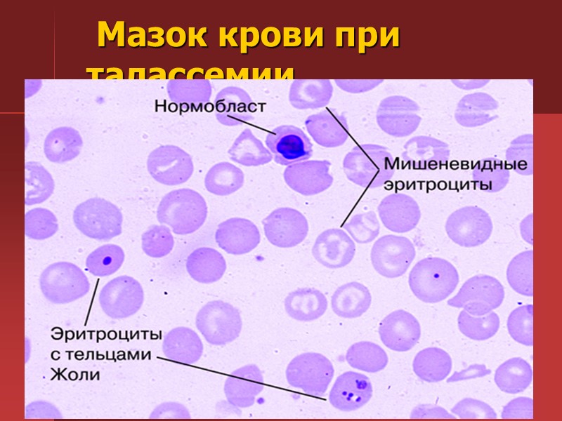 Картина крови при таллассемии (в поле зрения характерные мишеневидные эритроциты Картина крови при таллассемии (в поле зрения характерные мишеневидные эритроциты